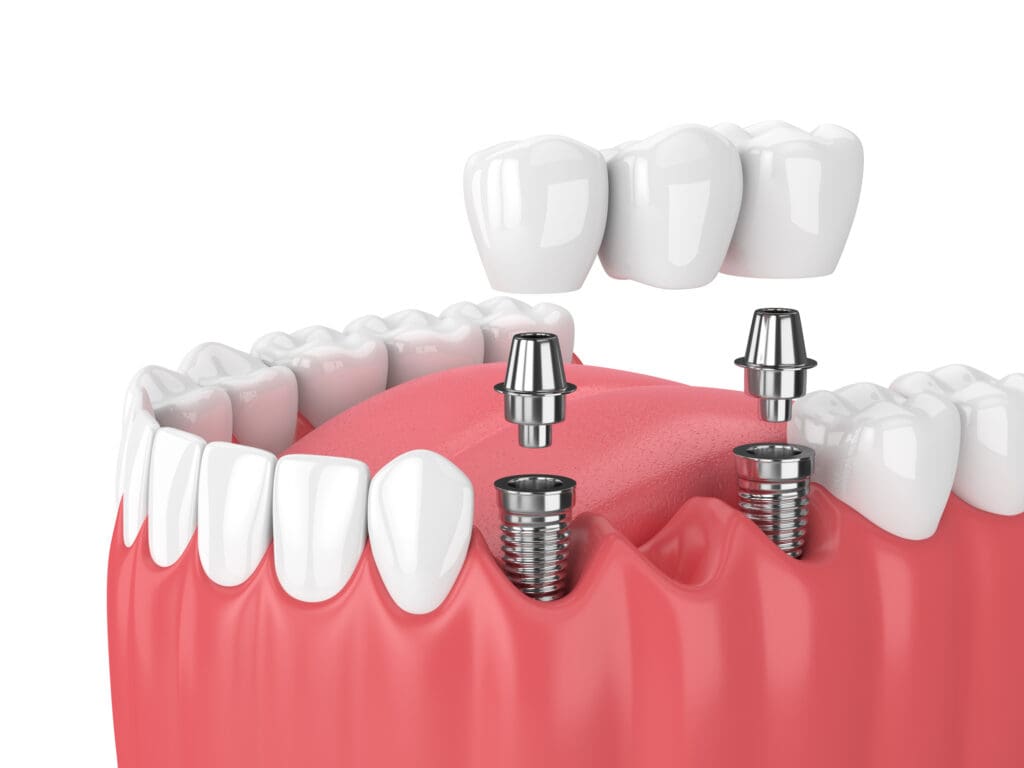 Dental implants in Bryn Mawr PA