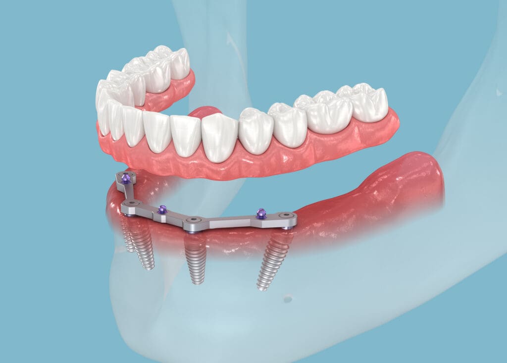Dental Implants in Bryn Mawr, PA