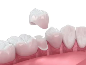 When Do You Actually Need A Dental Crown? in Bryn Mawr, PA