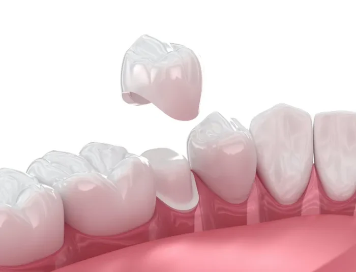 When Do You Actually Need A Dental Crown? in Bryn Mawr, PA